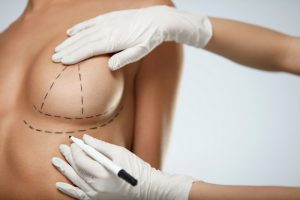 Подтяжка груди: виды и методы выполнения операции
