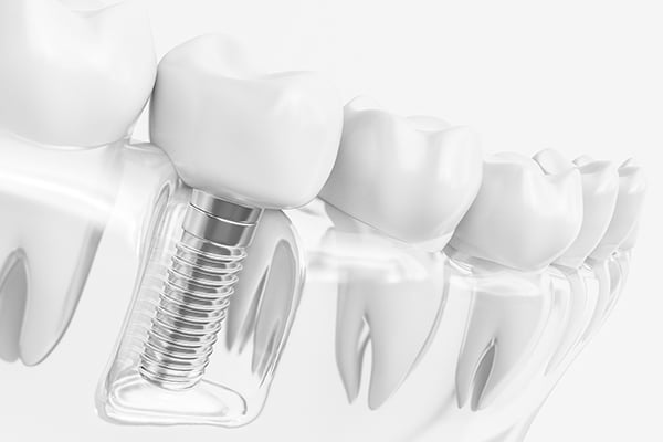 Одномоментная имплантация зубов vs. традиционная имплантация: сравнение результатов и преимуществ