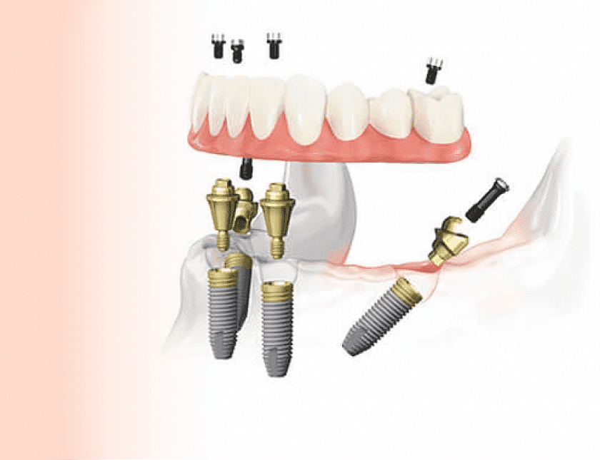 "Все на четырех": имплантация зубов All-on-4