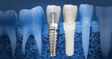 зубные имплантанты