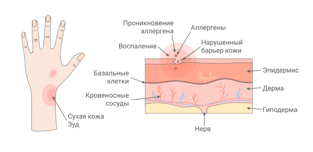 Аллергический контактный дерматит