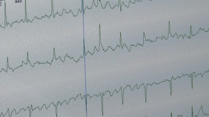 Холтер: как маленький прибор раскрывает тайны сердца - Новости на Вести.ru