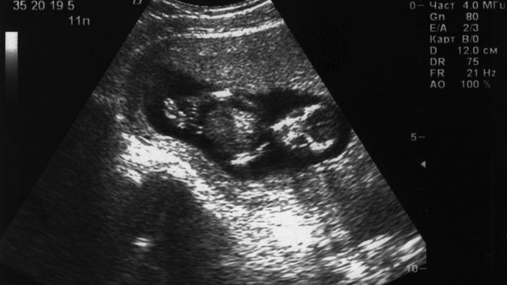 Минздрав предложил ввести учет препаратов для прерывания беременности
